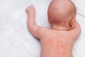 Inilah Cara Mengatasi Biang Keringat pada Bayi